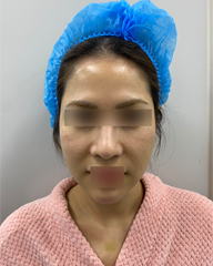 Trước điều trị